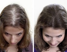 Что делать при выпадении волос после родов